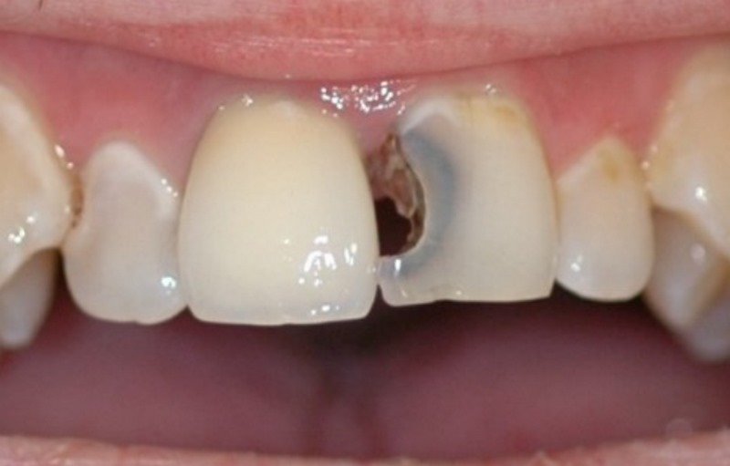 Chị em mơ thấy răng cửa bị sâu là điềm báo về tình duyên và con cái