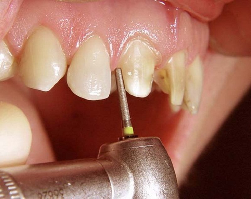 Mộng thấy em gái bị sâu răng cửa anh em đánh ngay 02 - 35