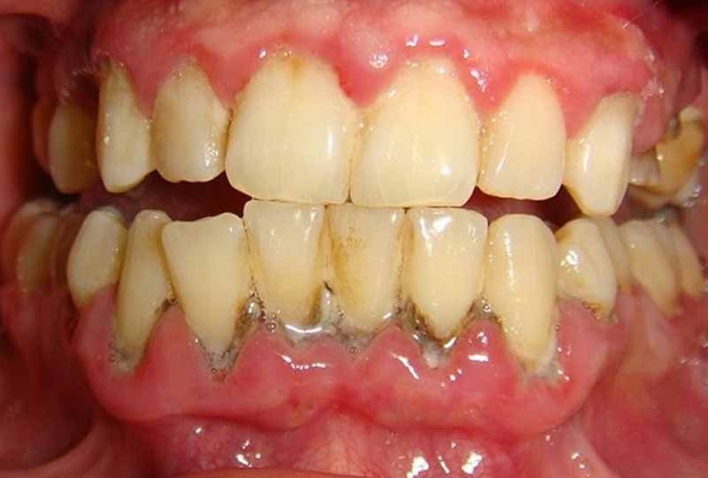 Mơ thấy răng cửa bị sâu khi ăn nho ở nhà người yêu là điềm báo tốt