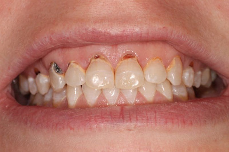 Mộng thấy răng người yêu cũ bị sâu các bạn đánh luôn 28 - 76